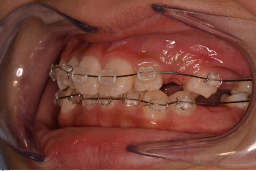 埋伏歯　矯正