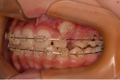 埋伏歯　矯正