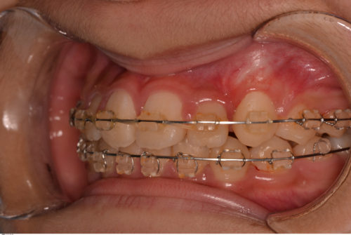 埋伏歯　矯正